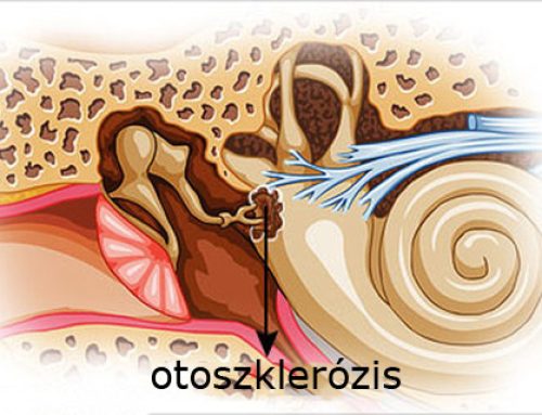 Otoszklerózis: amikor a fülzúgás halláscsökkenés mellett jelenik meg!