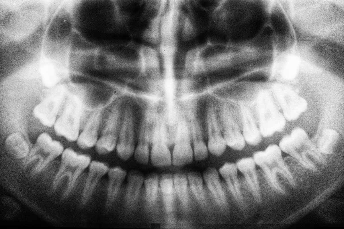 Fülzúgást okoz az ultrahangos fogkőleszedés!